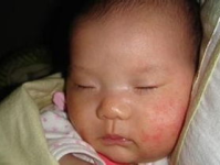 婴儿湿疹的治疗方法,婴儿湿疹全方位治疗指南